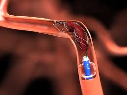 New devices causing 'paradigm shift' in stroke care Image credit: medscape.com